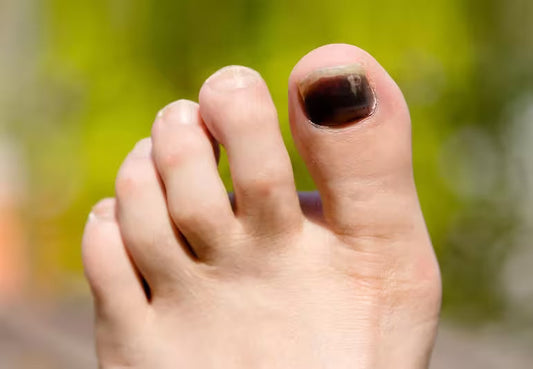 Black toe nail on foot